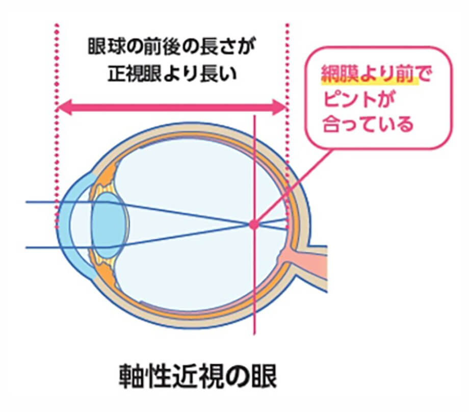 軸性近視の眼