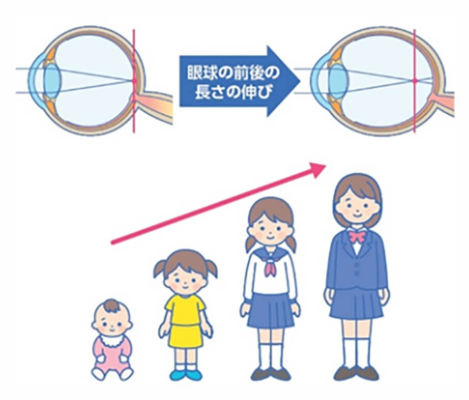 眼球の前後の長さの伸び