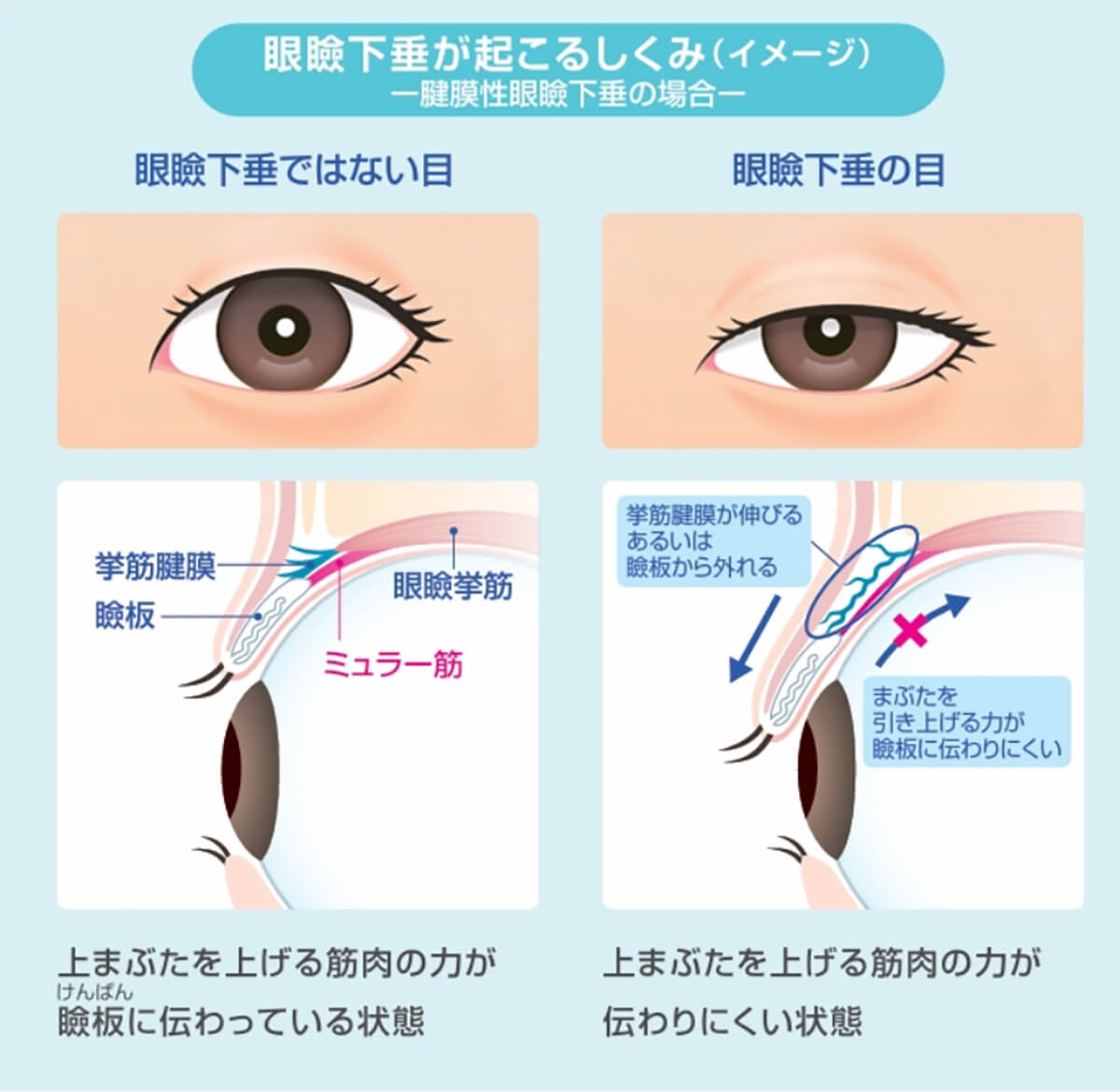 眼瞼下垂が起こる仕組み(イメージ)