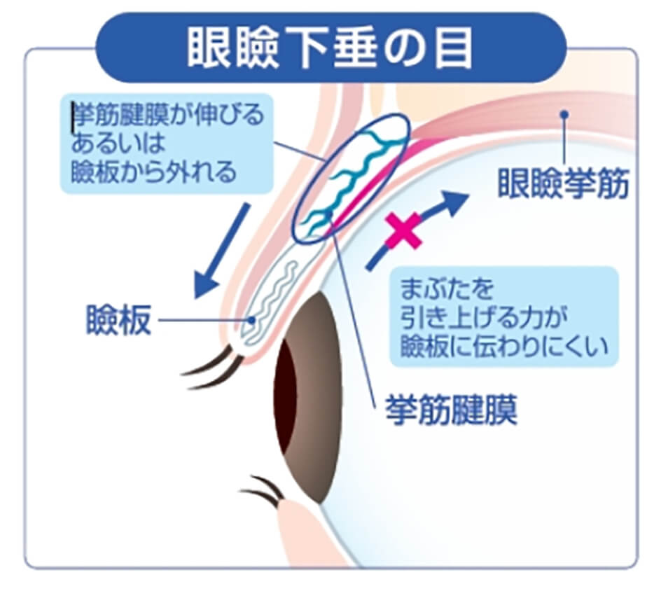 眼瞼下垂の目